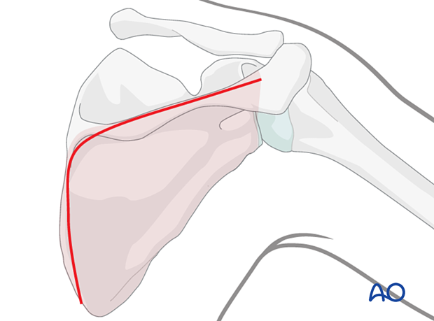 approach to the le fort i level of the midface in cleft lip and palate patients