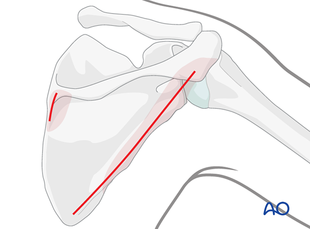 The Brodsky approach may be combined with a limited incision over the medial end of the scapular spine to control a medial border exit fracture line.