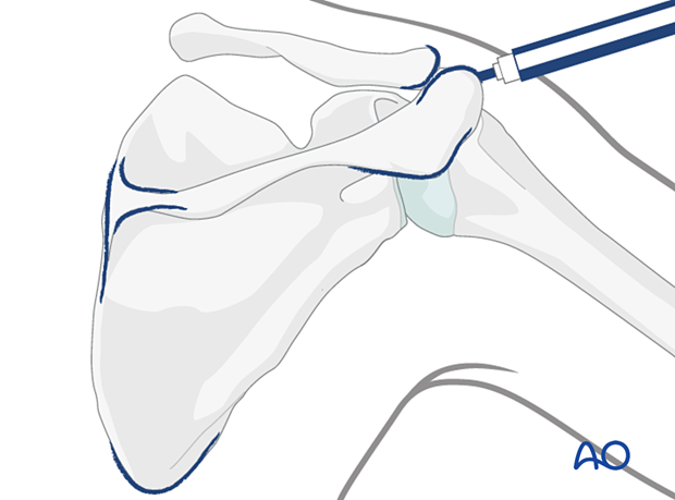 orif plate fixation