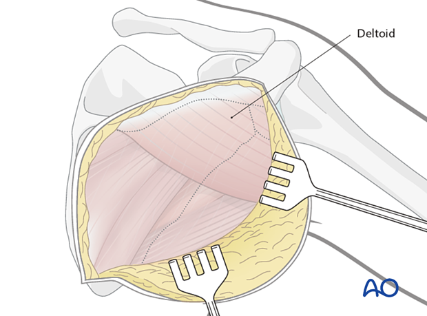 Skin elevation