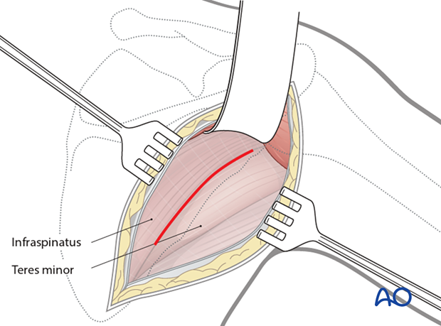 The deltoid muscle is retracted superiorly after incising the fascia over the inferior border of the muscle, taking care to avoid traction on the axillary nerve and posterior circumflex humeral artery laterally.