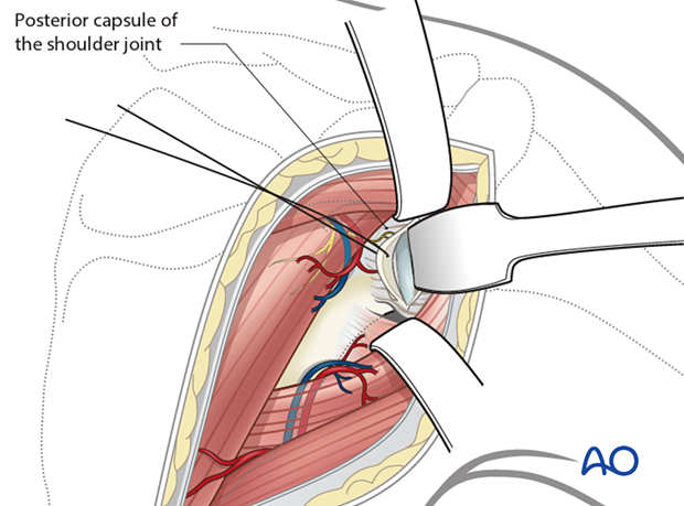 A transverse posterior glenohumeral arthrotomy exposes the glenoid fossa when checking for intra-articular fracture reduction and inadvertent penetration of the joint surfaces by fixation screws.