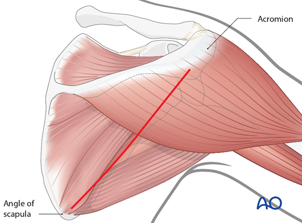 Lateral column approach