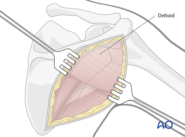 The skin is elevated at the epifascial level enough to expose the inferior border of the deltoid muscle.