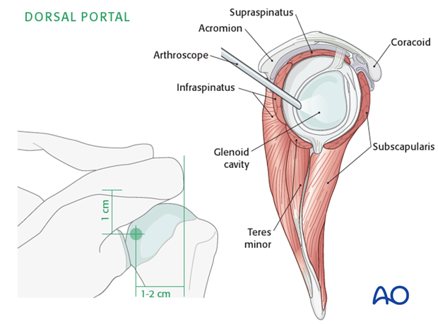 Arthroscopic entry points