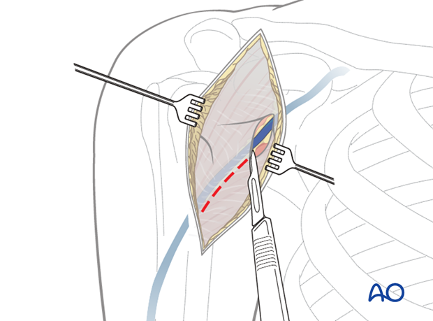 Exposure of deltopectoral interval 
