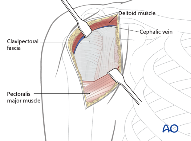 Dissection down to the deltopectoral groove