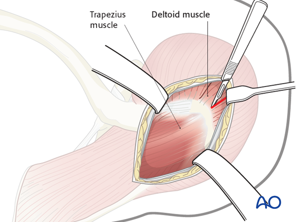 superior approach to the acromion