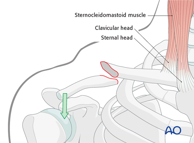 anterior approach