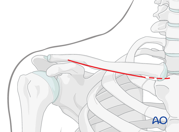 anterior approach