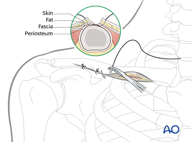 anterior approach