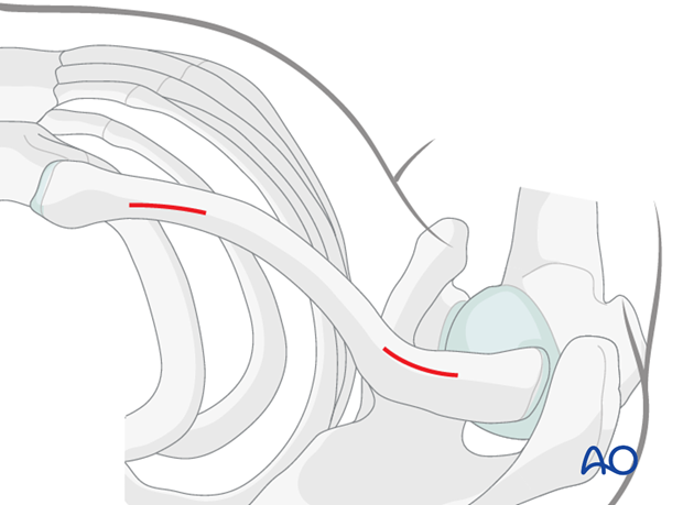 mipo   anterior approach