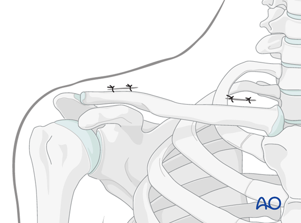 mipo   anterior approach