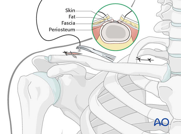 mipo   anterior approach