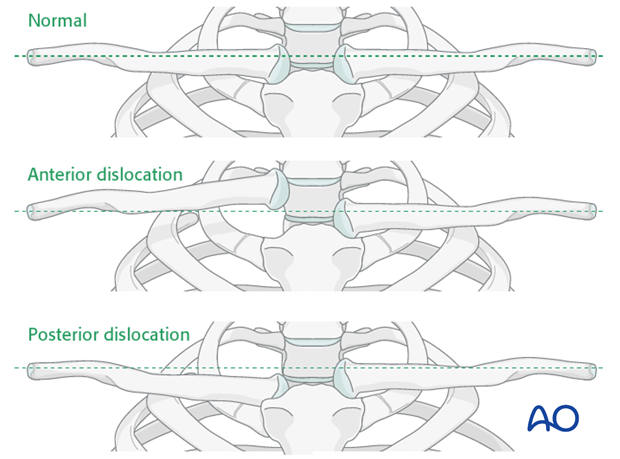 clinical and radiological examination of patients with clavicle injuries