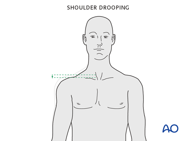 clinical and radiological examination of patients with clavicle injuries