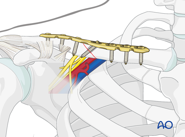 diaphyseal simple oblique