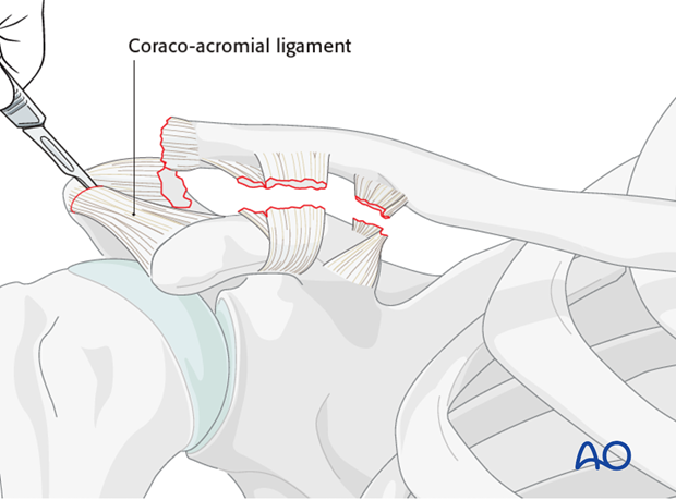 ligament reconstruction