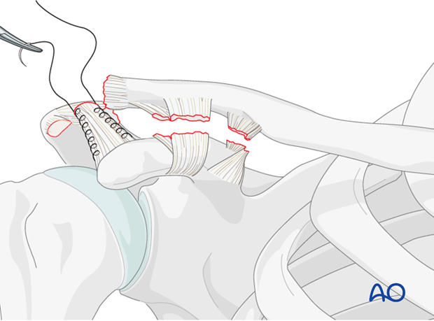 ligament reconstruction