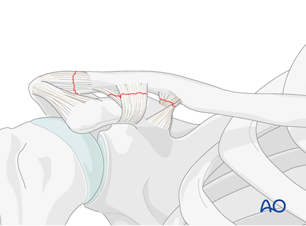 ligament reconstruction