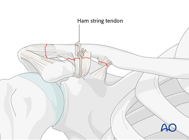 ligament reconstruction