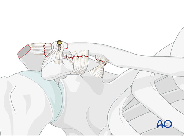 ligament reconstruction