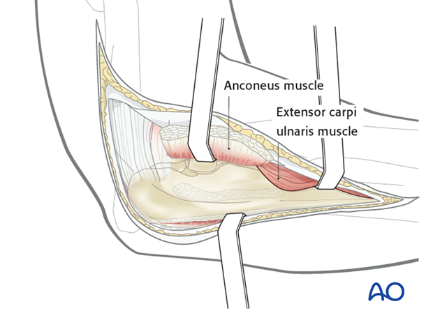 Boyd approach – Radial head exposure