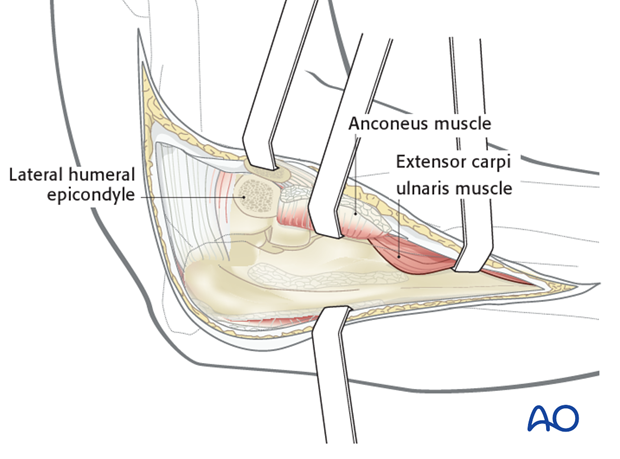 Boyd approach – Osteotomy of lateral humeral epicondyle