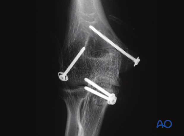 posterolateral approach