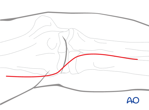 anterior approach