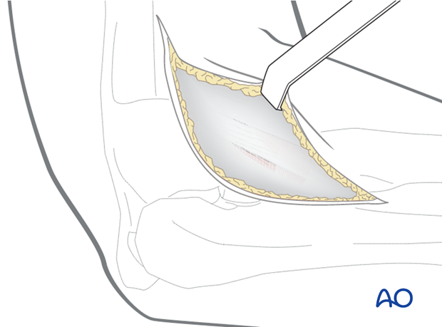 Lateral approach to proximal forearm – Kocher – Kaplan – Superficial dissection