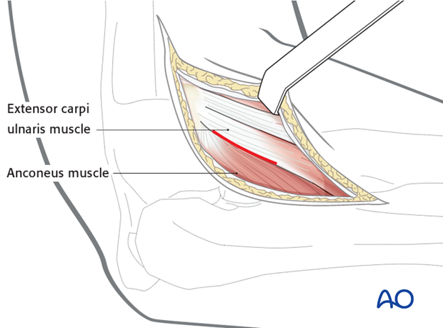 Lateral approach