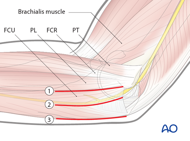 medial hotchkiss over the top