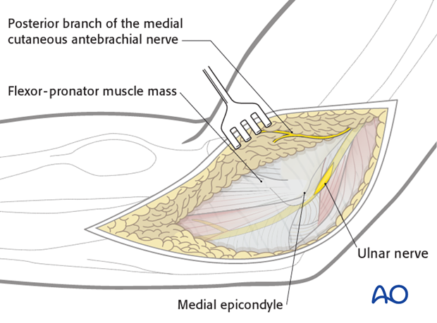 medial hotchkiss over the top