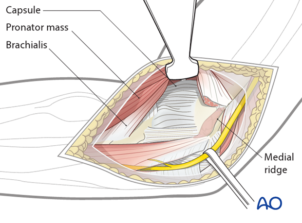 medial hotchkiss over the top