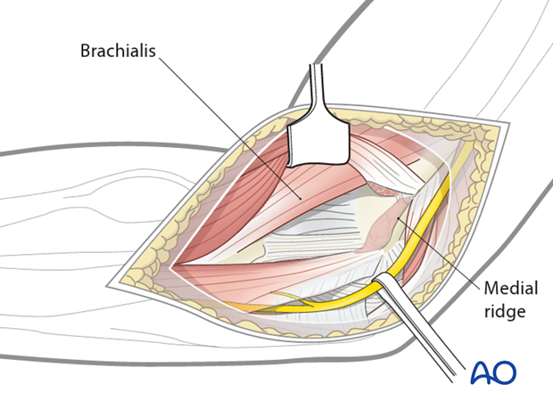 medial hotchkiss over the top