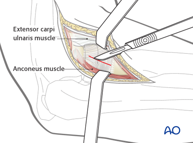 lateral approach to the proximal radius