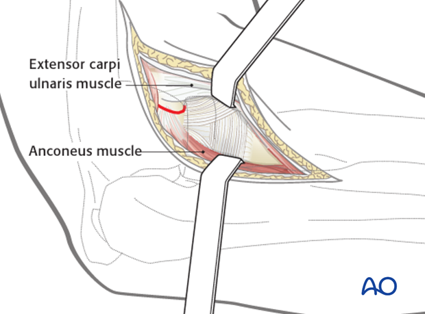 lateral approach to the proximal radius