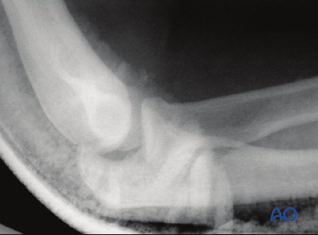 assessment of elbow stability