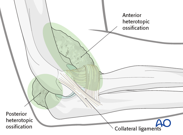 heterotopic ossification