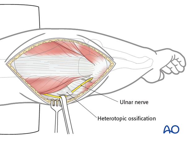 heterotopic ossification