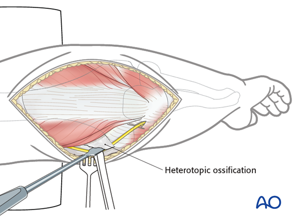 heterotopic ossification