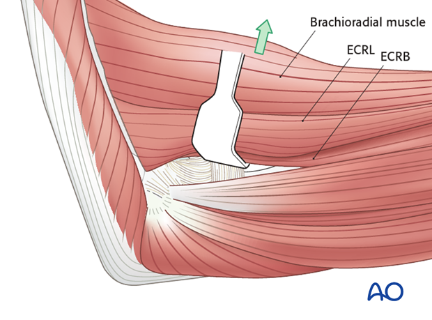 heterotopic ossification