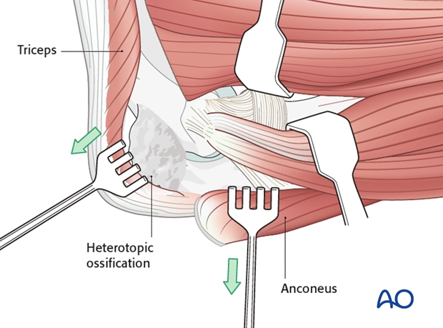 heterotopic ossification