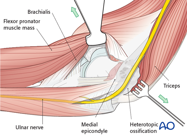 heterotopic ossification