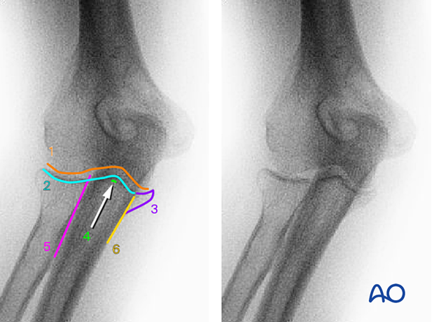 Anatomical lines and landmarks in AP view