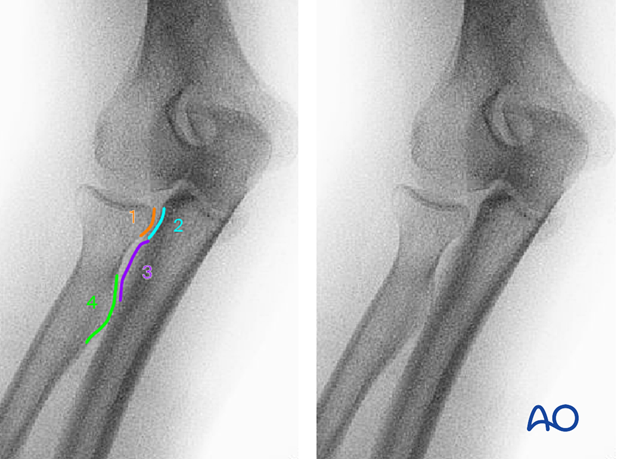 Anatomical lines and landmarks in AP view PRUJ