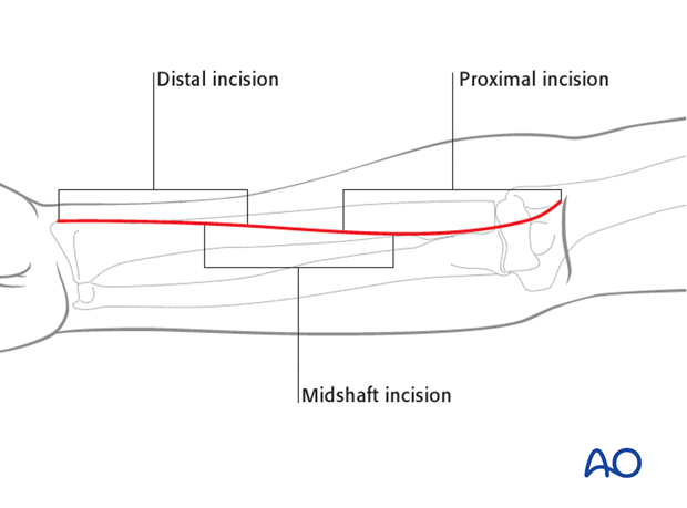 Anterior approach henry 