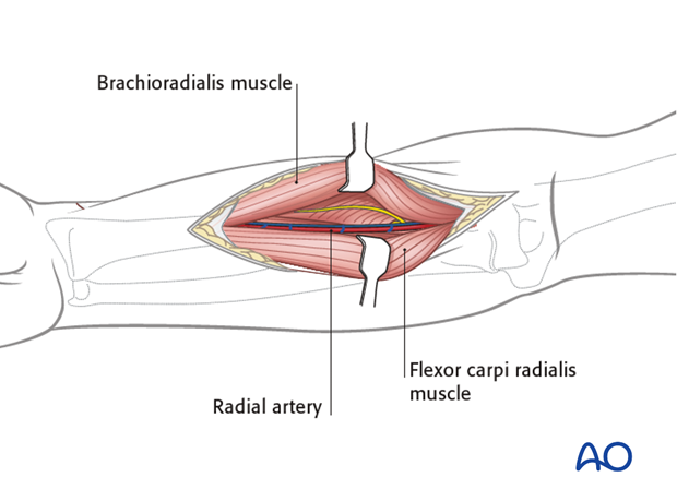 Anterior approach henry 