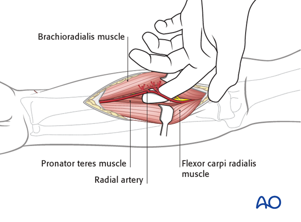 Anterior approach henry 